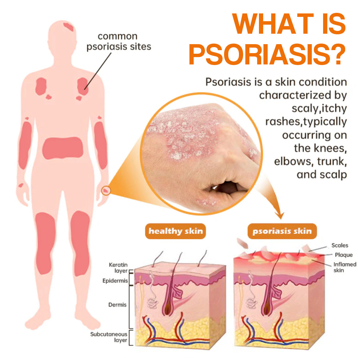 PsoriaHeal Bee Venom Psoriasis Treatment Spray pro
